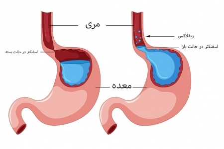 تغذیه مناسب برای درمان ریفلاکس معده 